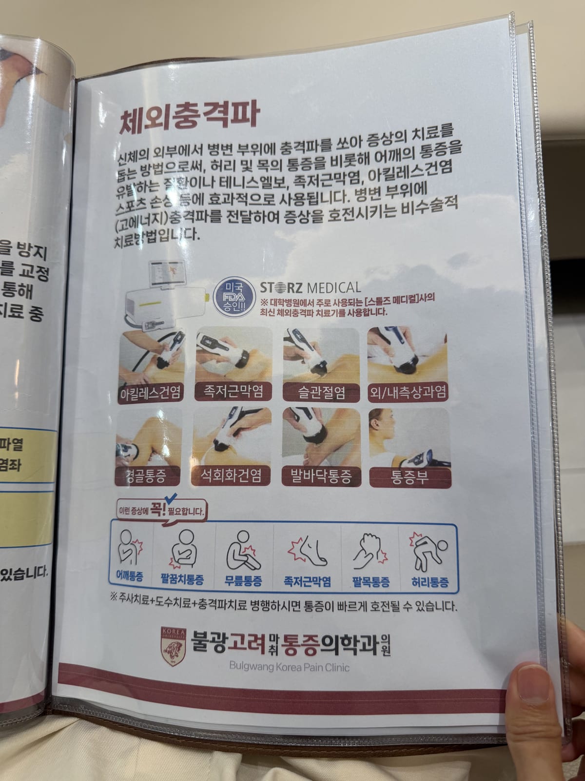 체외충격파 치료 안내